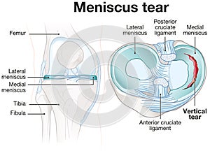 Meniscus tears. Medically illustration photo