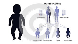 Menkes syndrome poster photo