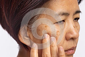 Menopausal women worry about melasma on face photo