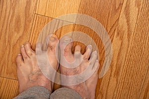 Mens hammer toes before surgery photo