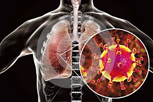 MERS virus, Meadle-East Respiratory Syndrome coronavirus photo