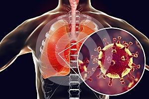 MERS virus, Meadle-East Respiratory Syndrome coronavirus photo