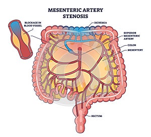 Mesenteric artery stenosis as blockage in blood vessel outline diagram