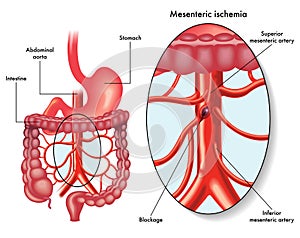 Mesenteric ischemia illustration