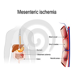 Mesenteric ischemia photo