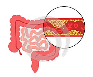 Mesentric ishemia disease