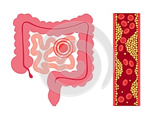 Mesentric ishemia disease