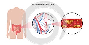 Mesentric ishemia disease