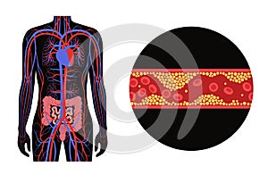 Mesentric ishemia disease