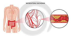 Mesentric ishemia disease
