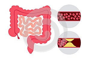 Mesentric ishemia disease