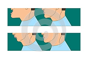 Mesial and distral bite