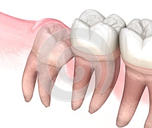 Mesial impaction of Wisdom tooth. Medically accurate tooth 3D illustration photo