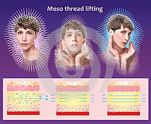 Meso thread Lift. Young female with clean fresh skin.