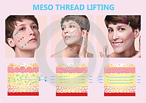 Meso thread Lift. Young female with clean fresh skin. Beautiful woman. face and neck.