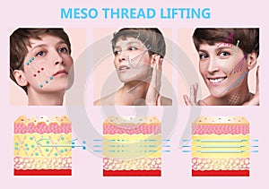 Meso thread Lift. Young female with clean fresh skin. Beautiful woman. face and neck. photo