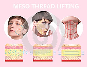 Meso thread Lift. Young female with clean fresh skin. photo