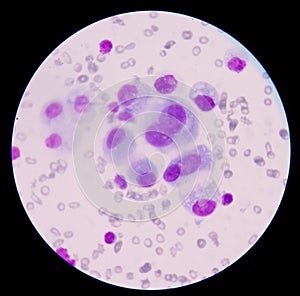 Mesothelial cells in body fluid.