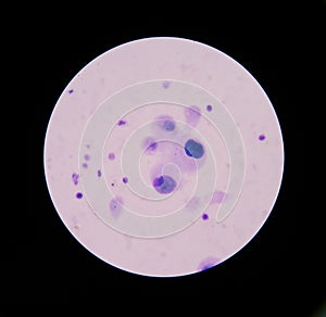 Mesothelial malignant cells with multiple nuclei