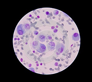 Mesothelial malignant cells with multiple nuclei