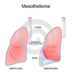 Mesothelioma. Lungs cancer photo