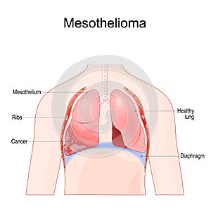 mesothelioma. Malignant tumor of lung photo