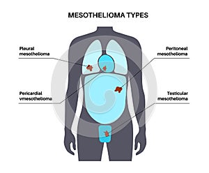 Mesothelioma tumor types