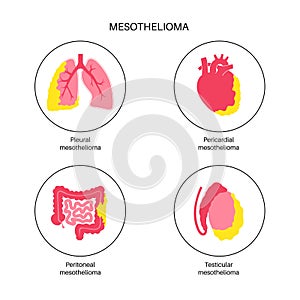 Mesothelioma tumor types photo