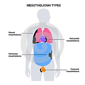 Mesothelioma tumor types photo