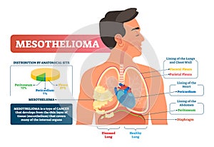 Mesothelioma vector illustration. Labeled lung cancer educational scheme. photo