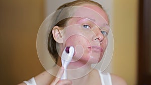 Mesotherapy at home. Girl mesorollerom handles the face of the house in front of the mirror