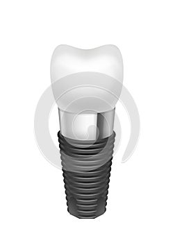 Metal assembled tooth implant