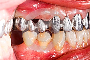 Metal Basis Dental Bridge