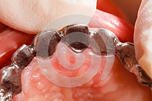 Metal Basis Dental Bridge