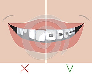 A metal braces and crooked teeth with a smile as a treatment concept in a dental or orthodontic clinic, a vector stock