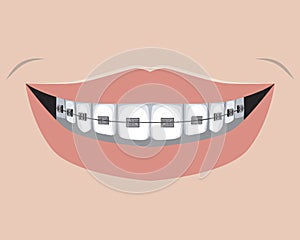 A metal braces with molars and smile of an adult or child, a flat vector stock illustration as a concept of dental treatment and