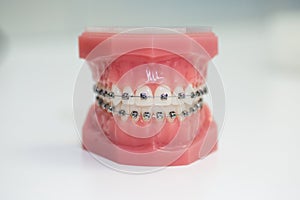 Metal Braces, Orthodontic Model