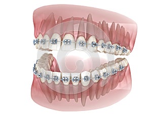 Metal braces and transparent dental model. Medically accurate 3D illustration