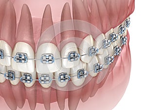 Kov šle a průhledný zubní. medicínský přesný  trojrozměrný ilustrace 