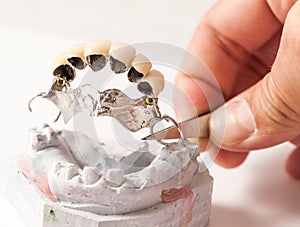 Metal Ceramic Bridge