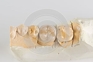 Metal ceramic dental crown photographed close-up