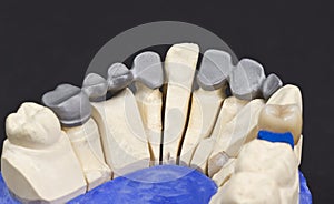 metal framework for a dental bridge