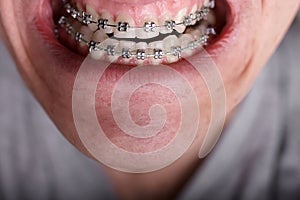 Metal orthodontic braces on crooked ugly teeth close-up. Ugly smile. Dental concept, medicinal alignment of teeth, brackets