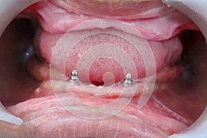 Metal tooth root implants