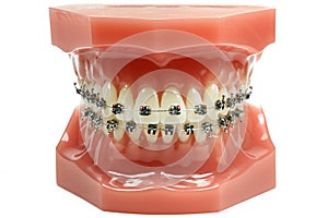 Metal wired dental braces