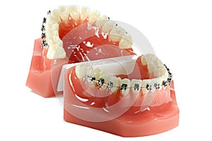 Metal wired dental braces