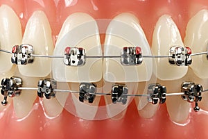 Metal wired dental braces