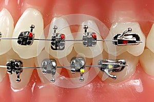 Metal wired dental braces