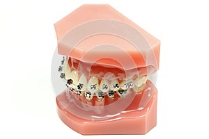 Metal wired dental braces