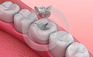 Metall dental fillings, Medically accurate illustration photo